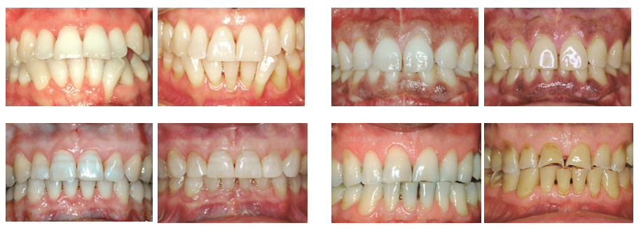 férula descarga bruxismo - Martinez Canut - Clínica Dental Valencia